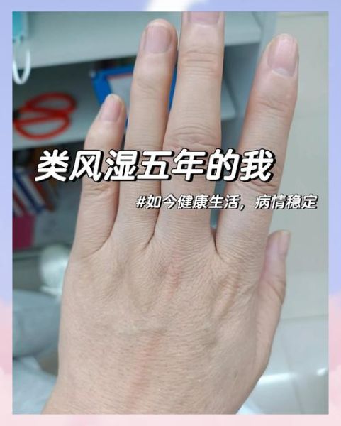 风湿性关节炎能治好吗_风湿病早期症状有哪些