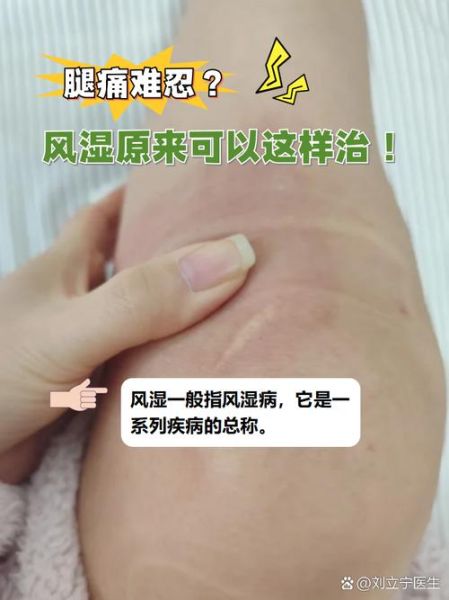 风湿性关节炎能治好吗_风湿病早期症状有哪些