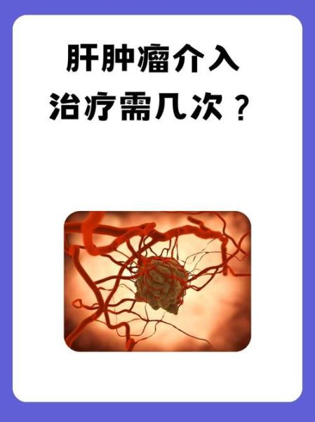 介入治疗适合哪些肿瘤_介入治疗能治愈癌症吗