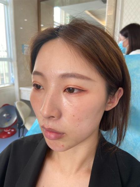 微整形能维持多久_微整形有哪些风险