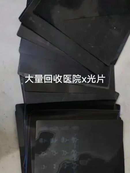 医用胶片会被数字影像替代吗_医用胶片未来发展趋势