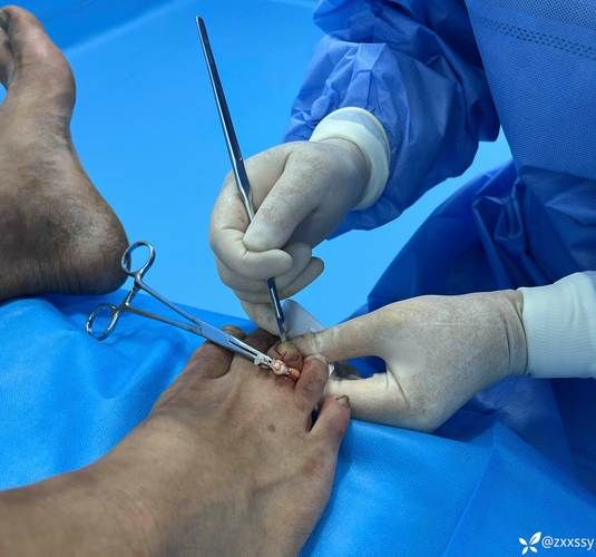 鸡眼扣是什么_鸡眼扣怎么选