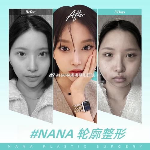 美容整形医院哪家好_术后恢复期多久