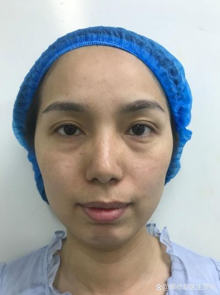 美容整形医院哪家好_术后恢复期多久