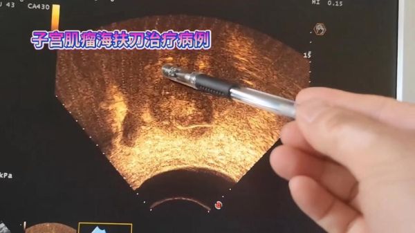 海扶刀治疗肿瘤效果怎么样_海扶前景值得投资吗