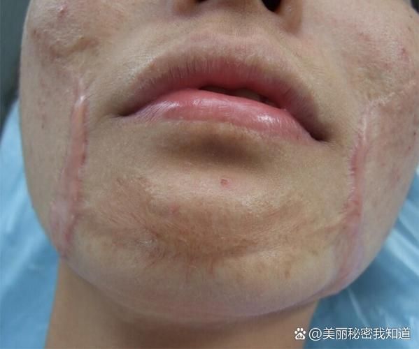 疤痕修复市场前景怎么样_疤痕修复行业赚钱吗